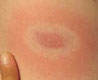 Borrelioosin ensioire on laajeneva kehämäinen ihottuma - alkuperäisen kuvan tekijä: Jongarrison (käyttäjätunnus wikipediassa).