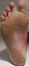 Jalkasieni - alkuperäisen kuvan tekijä: James Heilman, MD.