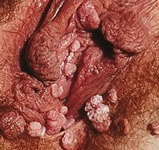 Kondylooma naisen ulkosynnyttimissä - alkuperäisen kuvan tekijä: SOA-AIDS Amsterdam.