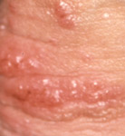 Kondylooma peniksen iholla.