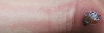 Märkäruvesta lähteviä punaisia juovia käsivarren ja ranteen iholla - alkuperäisen kuvan tekijä: James Heilman, MD.