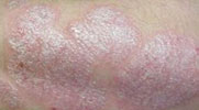 Läiskäpsoriasis miehen käsivarressa - alkuperäisen kuvan tekijä: Thomas Thurman.