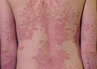 Psoriasis naisen selässä - alkuperäisen kuvan tekijä: James Heilman, MD.